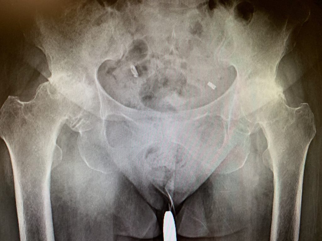 Case Study Bilateral hip replacement in 66 year old