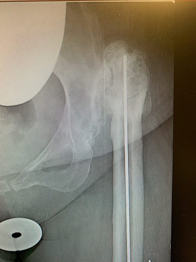 Case Study Complex Hip Replacement For Hip Dysplasia Femoral