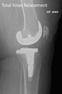 Postoperative X-ray of the left showing the anteroposterior and lateral view with total knee prosthesis in position