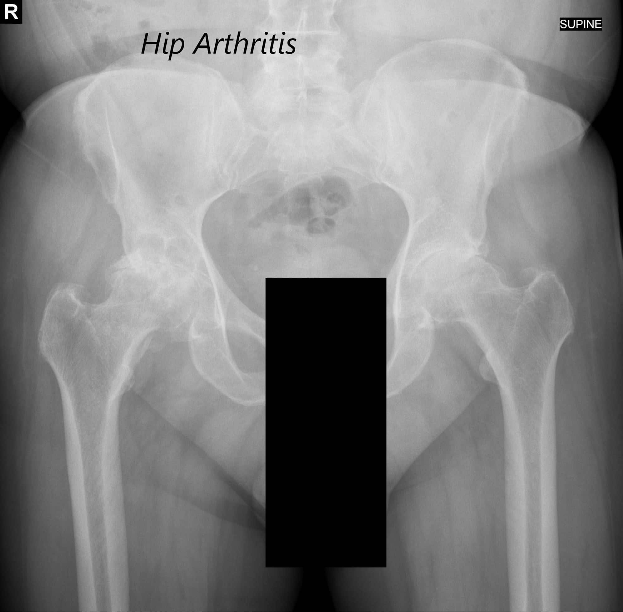 hip replacement xray