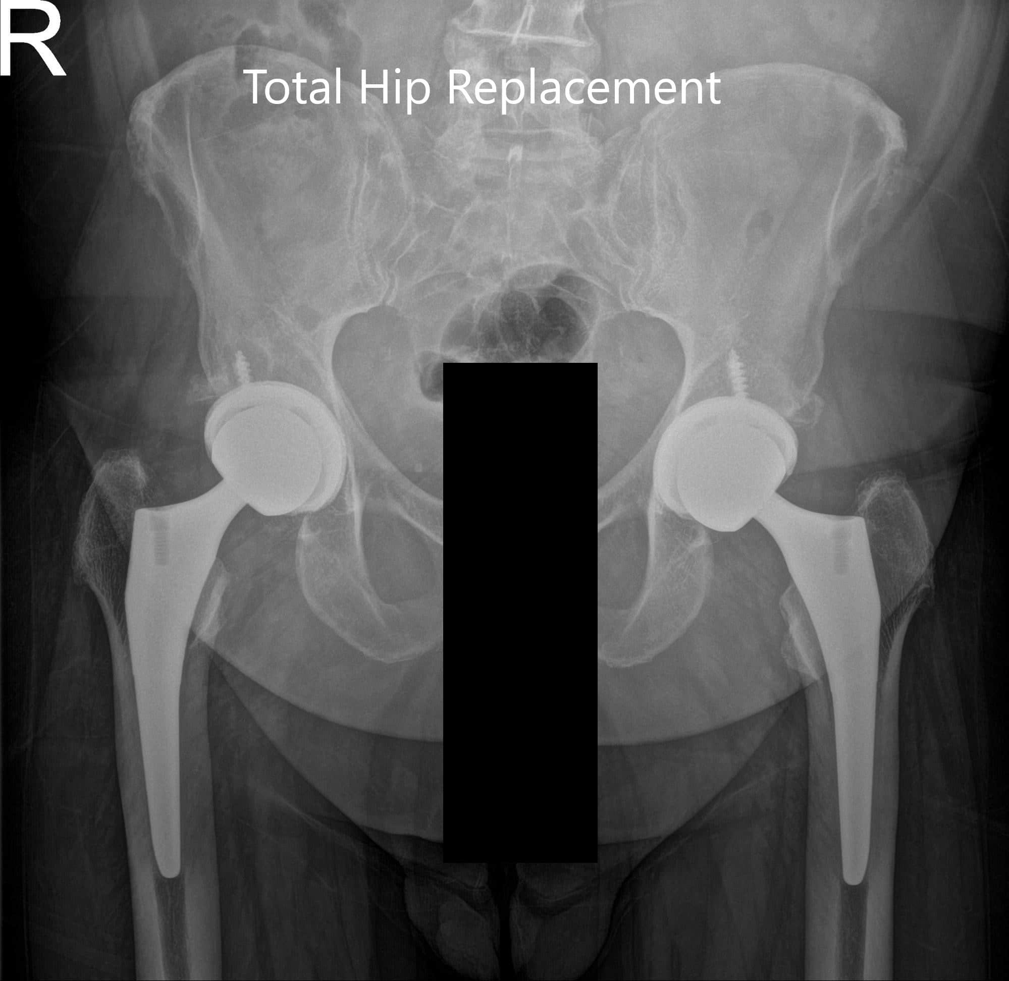 normal hip replacement xray