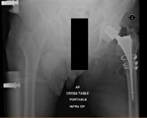 Radiografía postoperatoria que muestra la vista AP de la pelvis con ambas caderas, la cadera izquierda tiene alambres de cerclaje y espaciador de antibióticos in situ