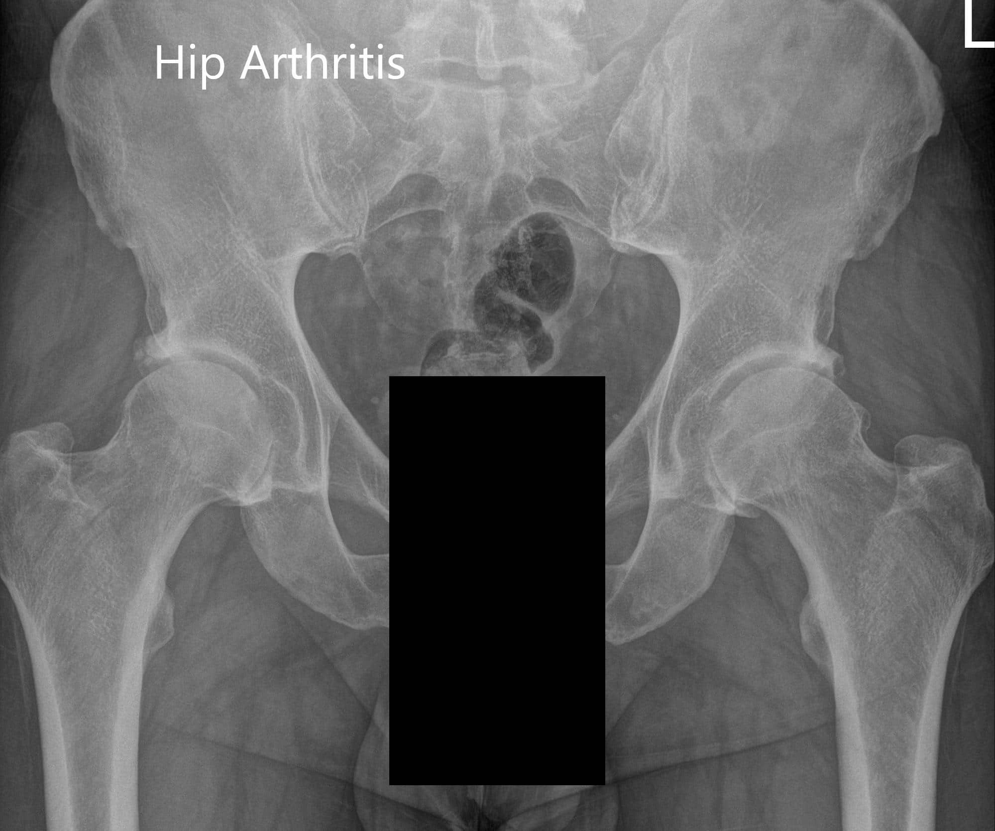 Hip And Pelvis X Ray