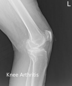 Preoperative X-ray of the left knee showing AP, lateral and merchant views - img 2