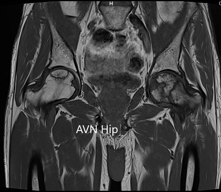 T1WI coronal section of MRI showing AVN hip