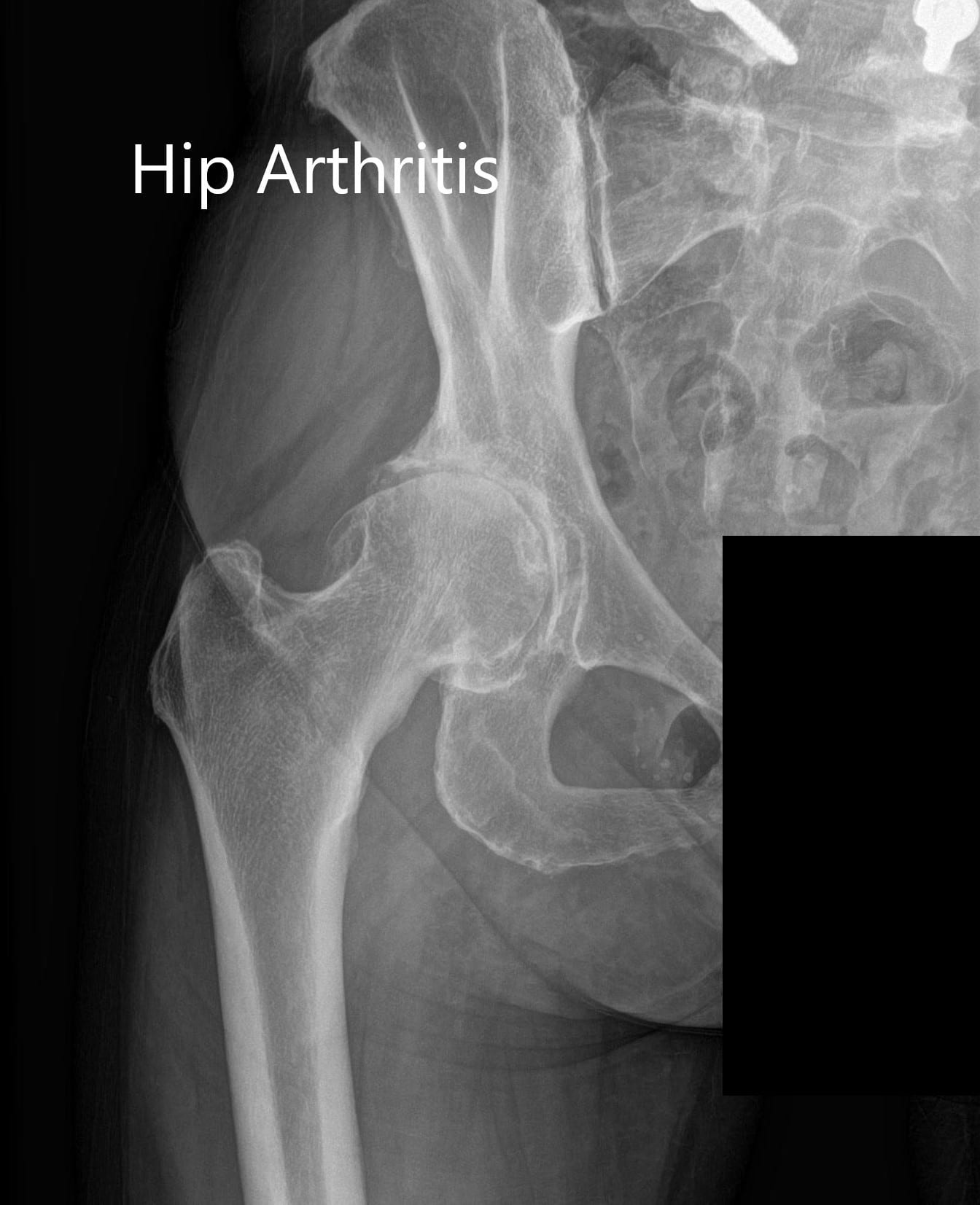 normal female adult right hip xray