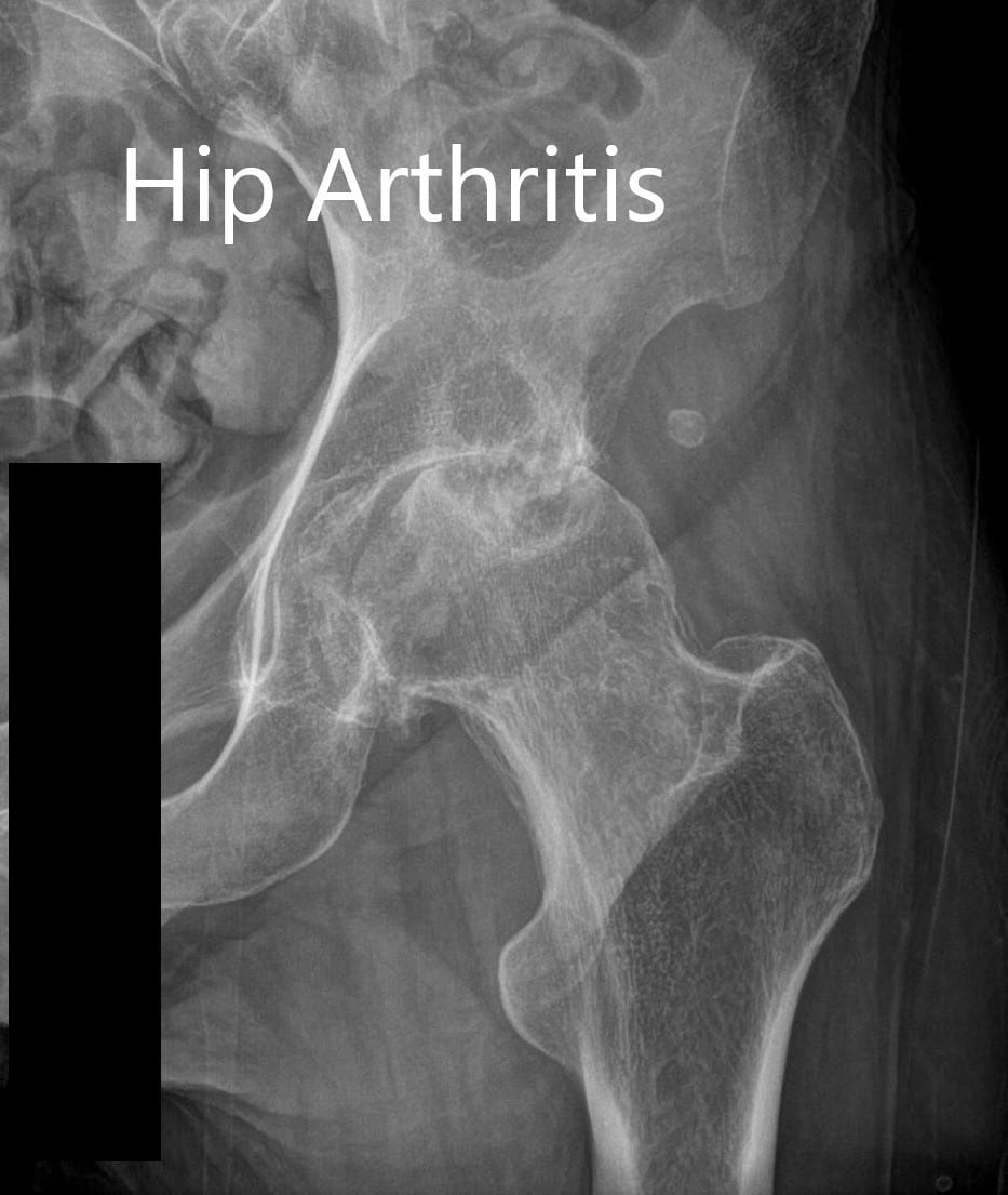 left hip xray normal vs arthritis