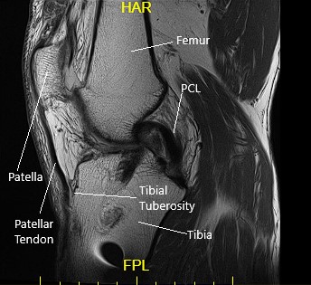 Sagittal MRI view of the left knee 2