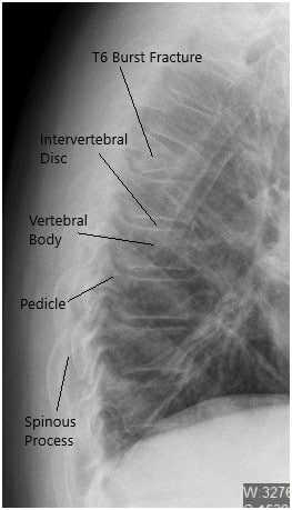 transverse process fracture x ray