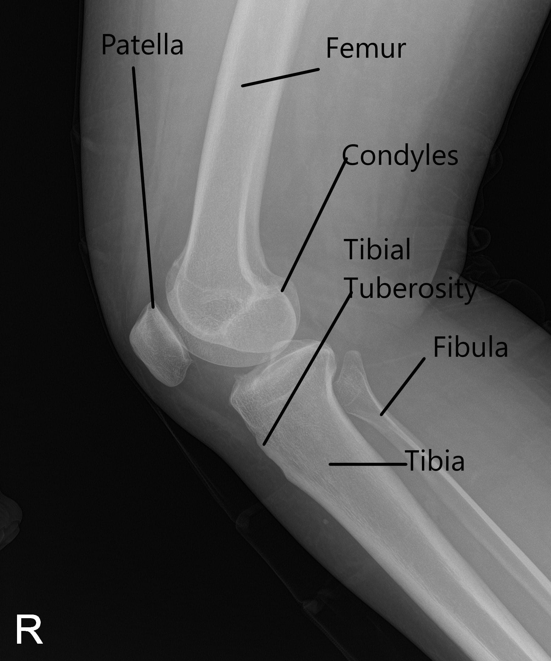 Case Study: Chondroplasty of Right Knee in 50 yr. Old Male