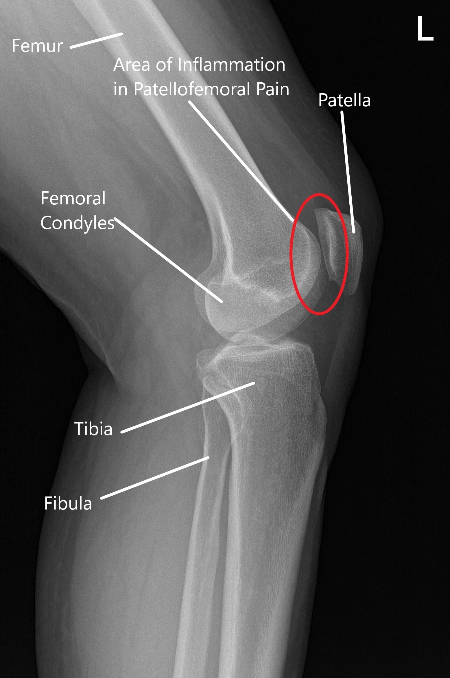Knee Xray Displays Basic Knee Joint Anatomy Including - vrogue.co