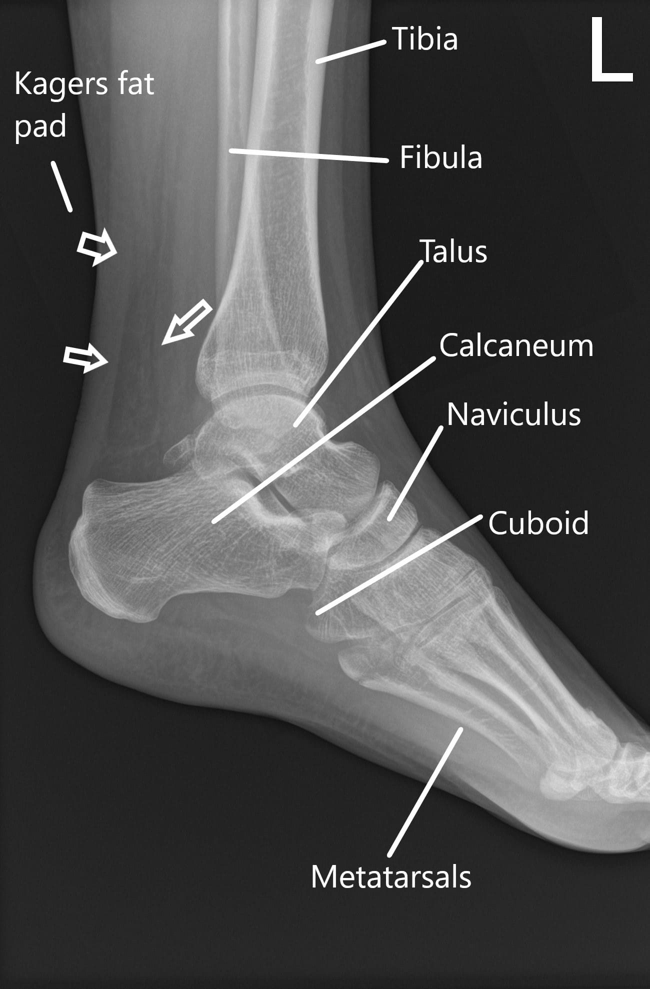 pain lateral to achilles tendon