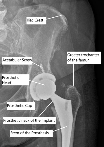 Robotic Hip and Knee Replacement Procedures