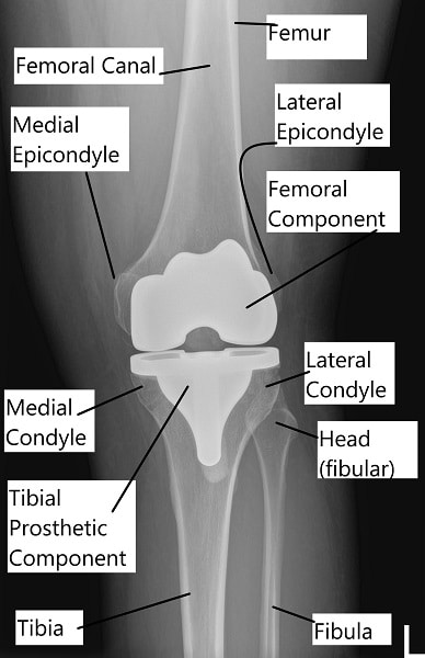 Total Joint Surgery Information  Orthopaedics and Rehabilitation