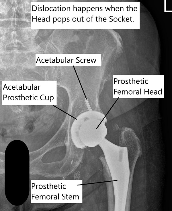 Total Hip Joint Dislocation - Complete Orthopedics