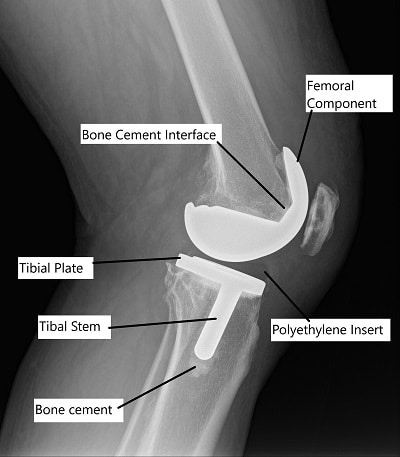Cemented and Cementless Knee Replacement - Complete Orthopedics