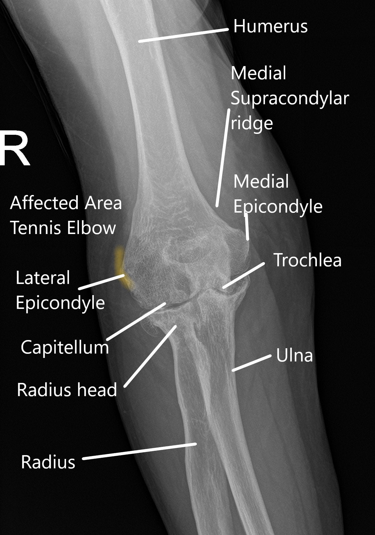 elbow anatomy xray