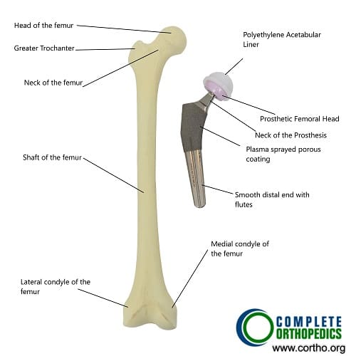 What Equipment Is Needed After Hip Replacement?