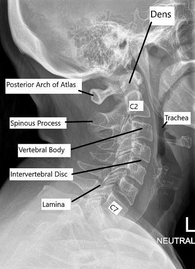 x ray cervical spine normal