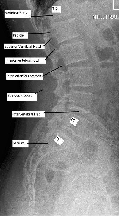 lumbar vertebrae anatomy xray