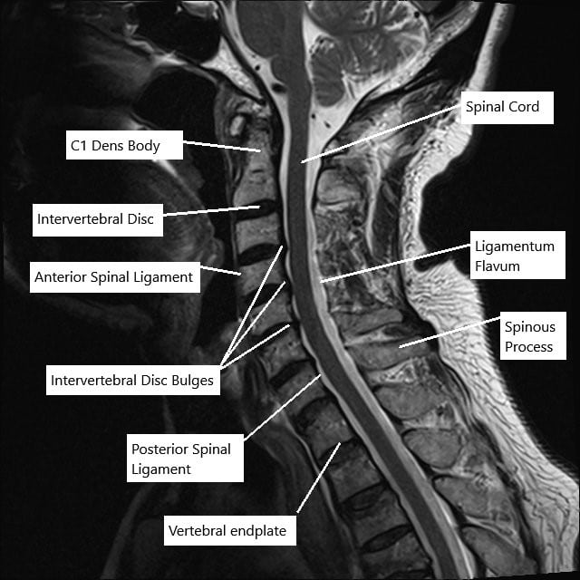 Mri Cervical Spine Lumbar Spine Mri Scan Images Spinal Stenosis ...