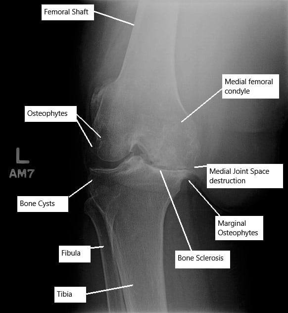 xray of normal hip joint vs osteoarthritic