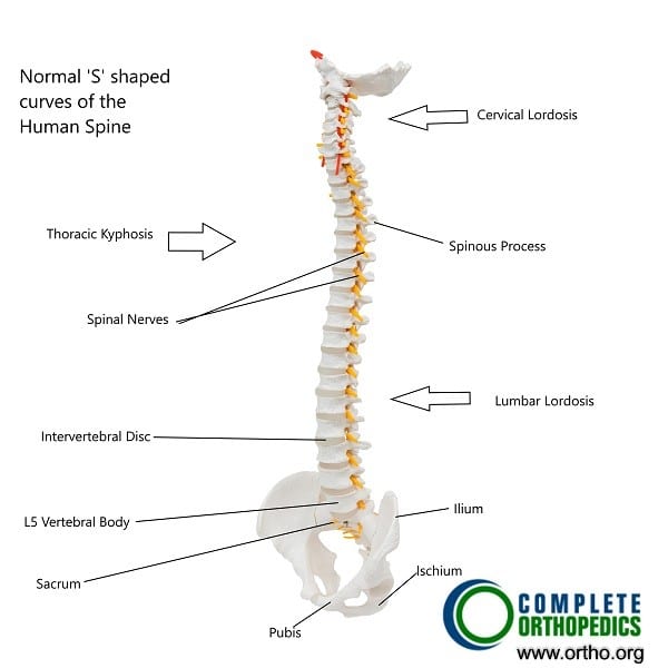 Flatback Syndrome - Complete Orthopedics