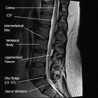 Piriformis Syndrome – Advanced Pain & Spine Management