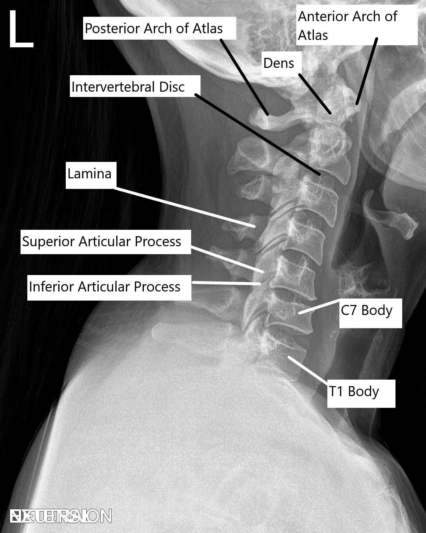 base and body cervical spine x ray