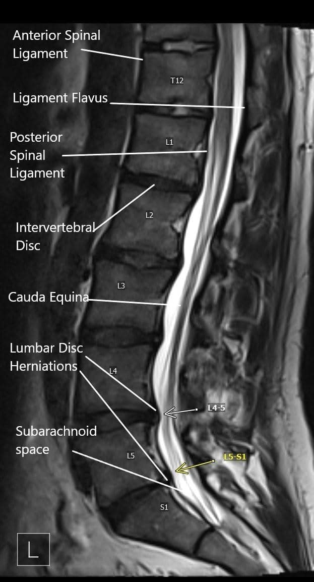 Todo sobre el segmento vertebral L5-S1 (articulación lumbosacra)