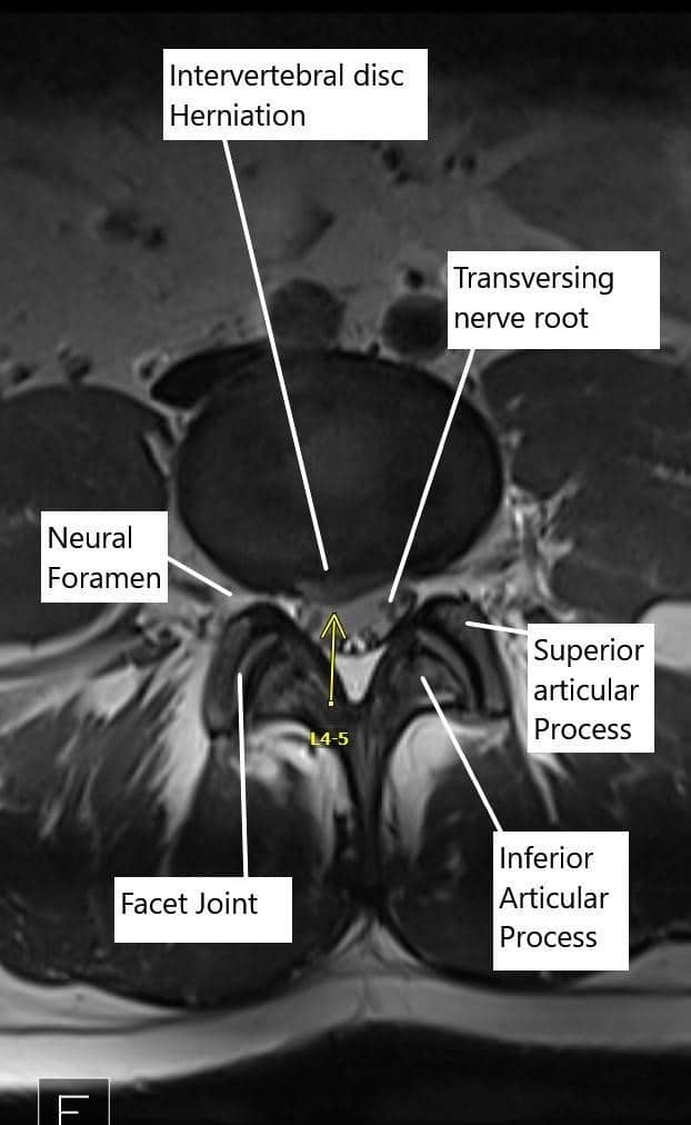 Todo sobre el segmento vertebral L5-S1 (articulación lumbosacra