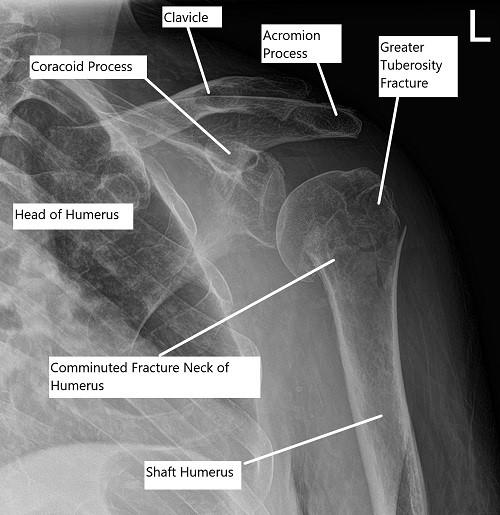comminuted fracture greater tuberosity humerus