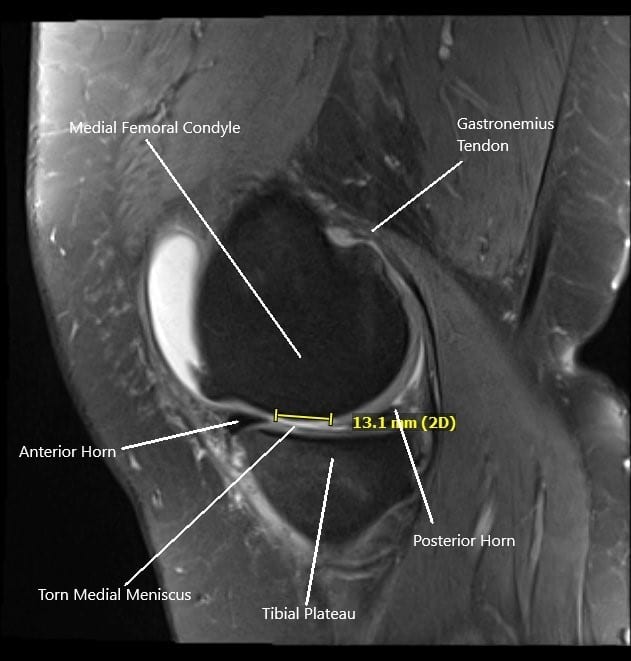 Case Study: Meniscus Tear Management in 55 Year Old Male