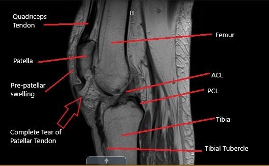 Case Study: Patellar Tendon Rupture in 70 Year Old Male