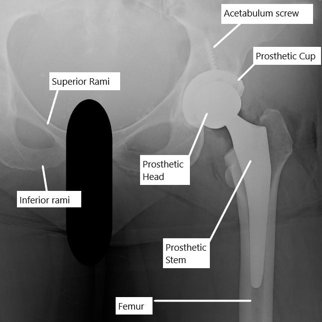 https://www.cortho.org/wp-content/uploads/2021/05/Pain-after-Hip-Replacement.jpg