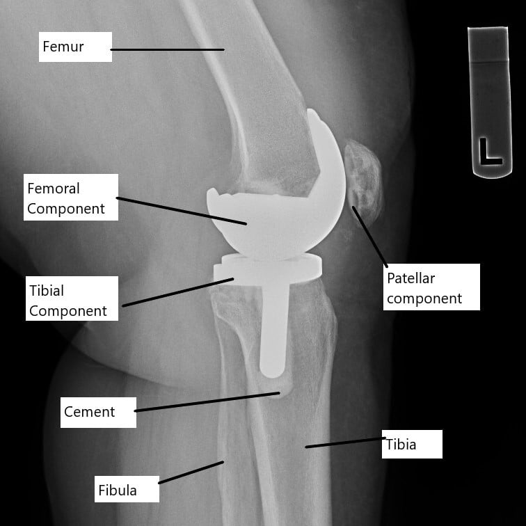 Reducing Post-Operative Pain from Knee Replacement