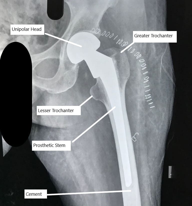 Revision hip replacement surgery