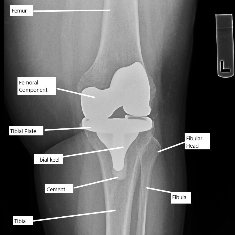 How long after knee replacement does the stiffness go away?