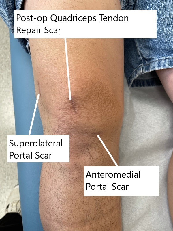 The patient's right leg indicating suture and surgical scars