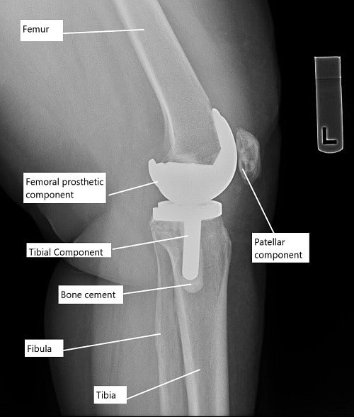 https://www.cortho.org/wp-content/uploads/2021/06/Dos-and-Donts-after-Knee-Replacement.jpg