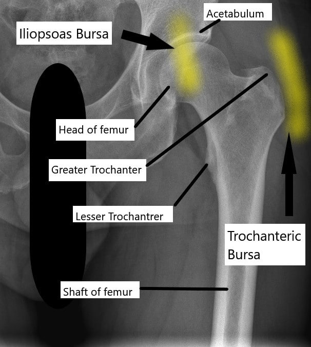 Hip Bursitis: Symptoms, Risk Factors and Complications