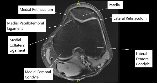 Medial Patellofemoral Ligament Reconstruction - Complete Orthopedics