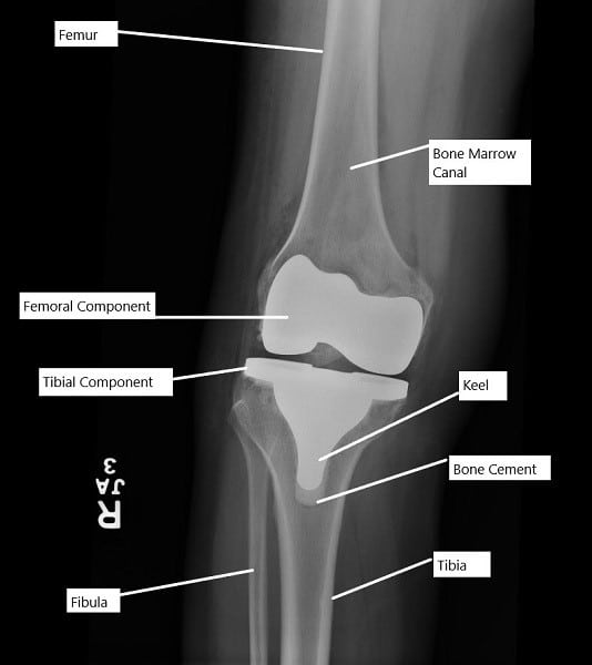 Complications After Total Knee Replacement General Ce - vrogue.co