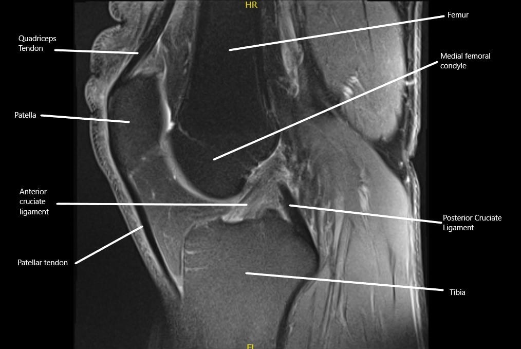 Lesión del ligamento cruzado posterior - Ortopedia completa