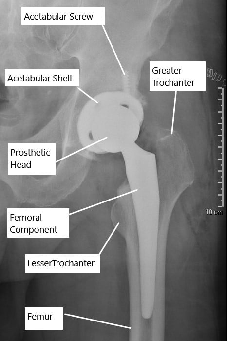 Uncemented Vs Cemented Total Hip Replacement