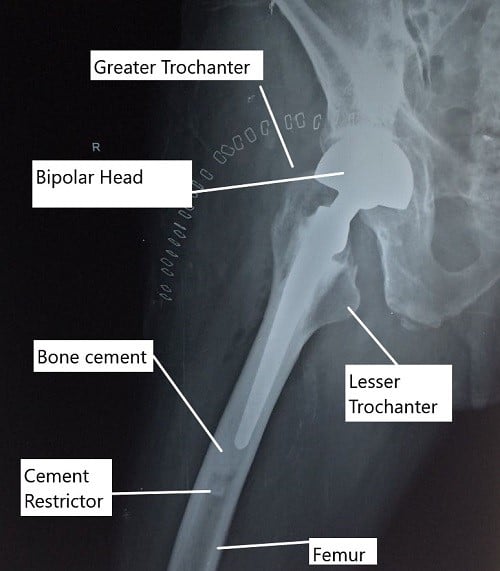 Partial hip replacement surgery