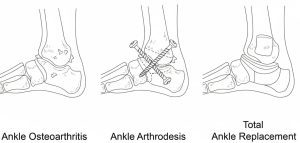 Ankle Osteoarthritis 1
