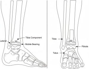 Line drawing of ankle replacement hardware